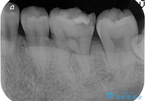 オールセラミッククラウン 欠けてしまった歯の治療の治療前