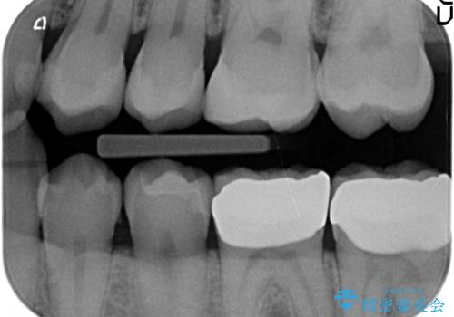 放置した虫歯の治療 親知らずの手前が虫歯の治療後