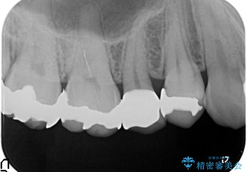 オールセラミッククラウン 銀歯を白くの治療後