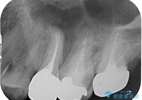 痛い奥歯 セラミッククラウンでのむし歯治療の治療前