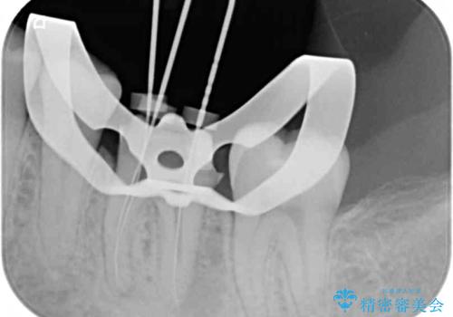 奥歯が痛い 根管治療とオールセラミッククラウンの治療中