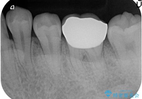 オールセラミッククラウン 欠けてしまった歯の治療の治療後