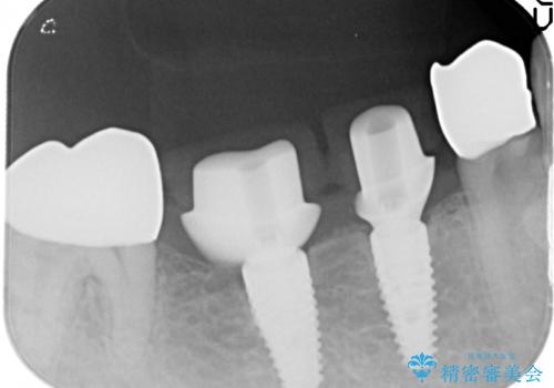 銀歯だらけの口の中を改善したいの治療中