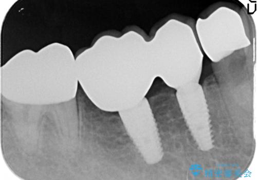 銀歯だらけの口の中を改善したいの治療後