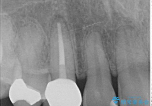 オールセラミッククラウン(スペシャル)　根管治療後の補綴の治療後