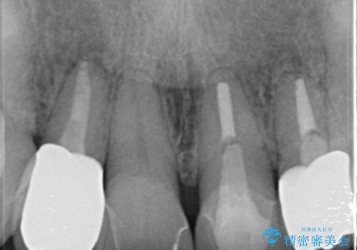 歯ぐきの黒ずみ クラウンやりかえによる改善の治療後