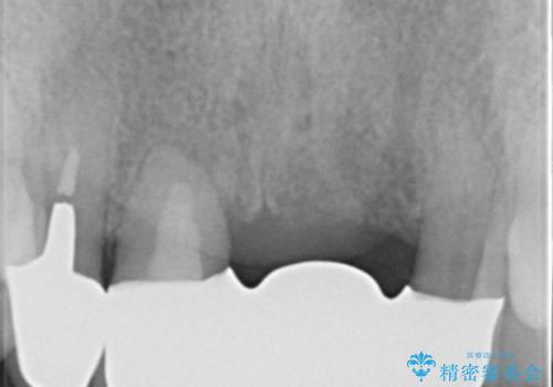 前歯が抜けそう ブリッジできれいに 70代女性の治療後