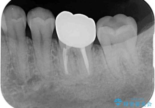 奥歯が痛い 根管治療とオールセラミッククラウンの治療後