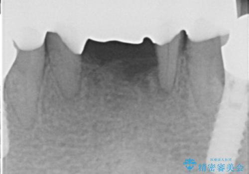 前歯が抜けそう ブリッジできれいに 70代女性の治療後