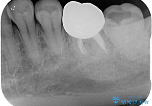 奥歯が痛い 根管治療とオールセラミッククラウンの治療後