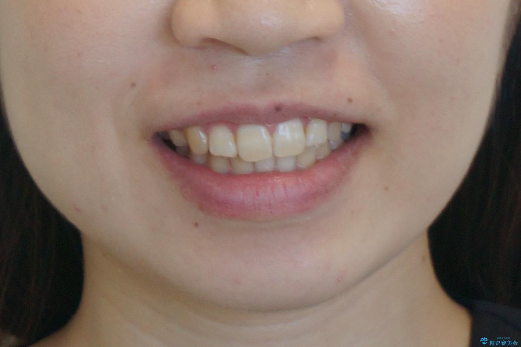 よくある悩み 前歯が裏に2本入っているのを治したいの治療後(顔貌)