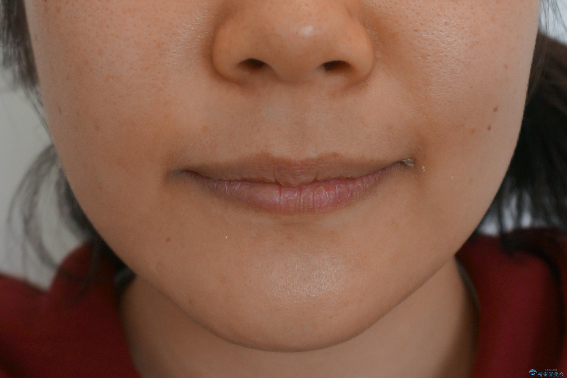 「整形した?」と言われるほどの変化! 口元を矯正治療で改善 鼻を高くしたわけでも、アゴに何か入れたわけでもありません。の治療後(顔貌)