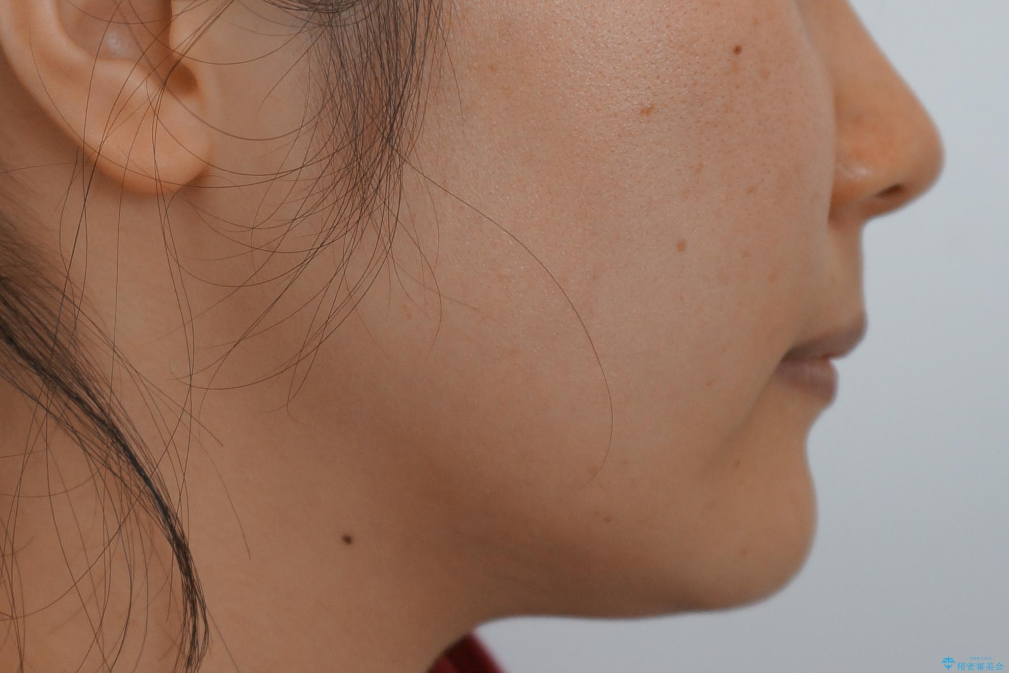 「整形した?」と言われるほどの変化! 口元を矯正治療で改善 鼻を高くしたわけでも、アゴに何か入れたわけでもありません。の治療後(顔貌)