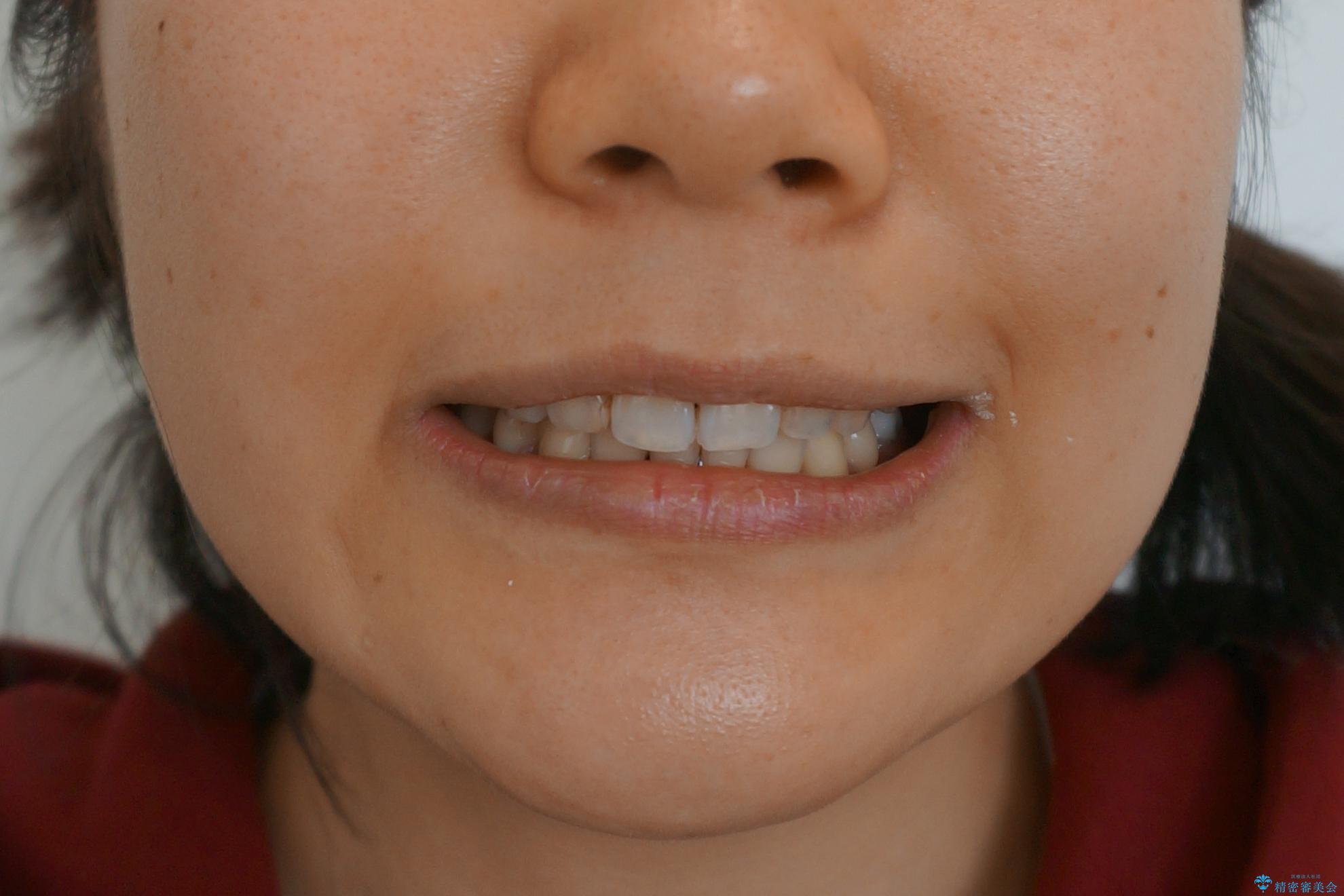 「整形した?」と言われるほどの変化! 口元を矯正治療で改善 鼻を高くしたわけでも、アゴに何か入れたわけでもありません。の治療後(顔貌)