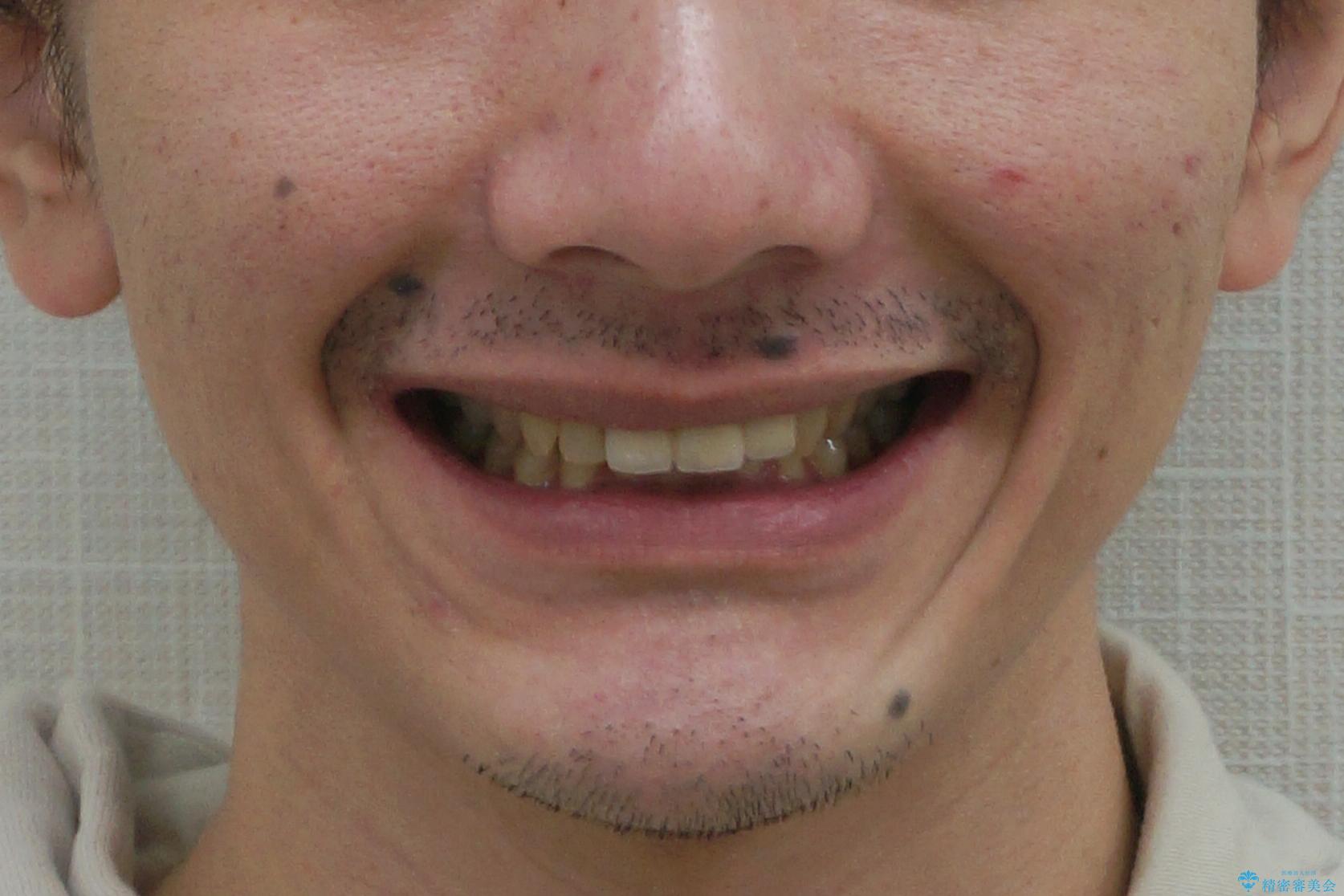 前歯にボールが当たってダメになってしまった とりあえず横の歯に接着剤でつけてしのいでいたのを、しっかりブリッジで治療の治療後(顔貌)