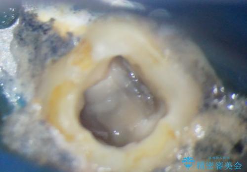 奥歯が痛い 根管治療とオールセラミッククラウンの治療前