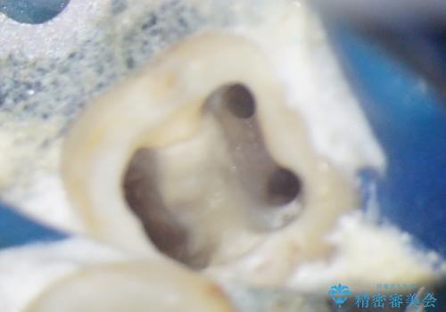 奥歯が痛い 根管治療とオールセラミッククラウンの治療中