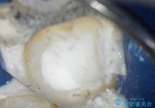 奥歯が痛い 根管治療とオールセラミッククラウンの治療後