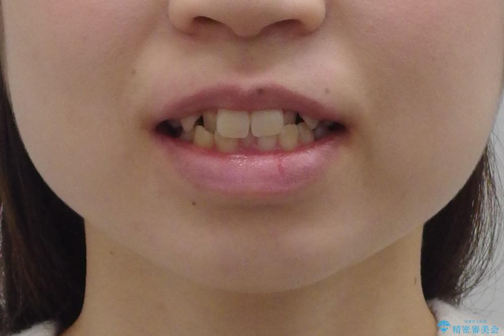 よくある悩み 前歯が裏に2本入っているのを治したいの治療前(顔貌)