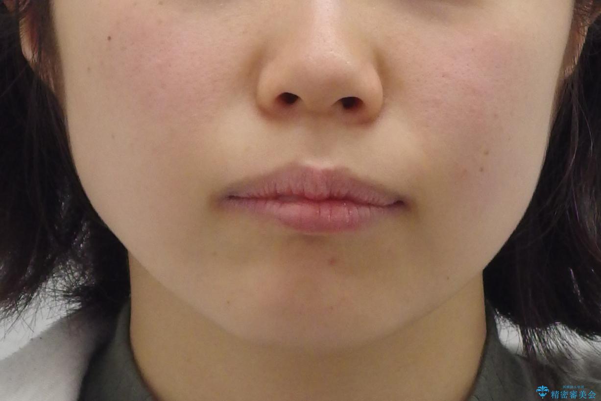 「整形した?」と言われるほどの変化! 口元を矯正治療で改善 鼻を高くしたわけでも、アゴに何か入れたわけでもありません。の治療前(顔貌)