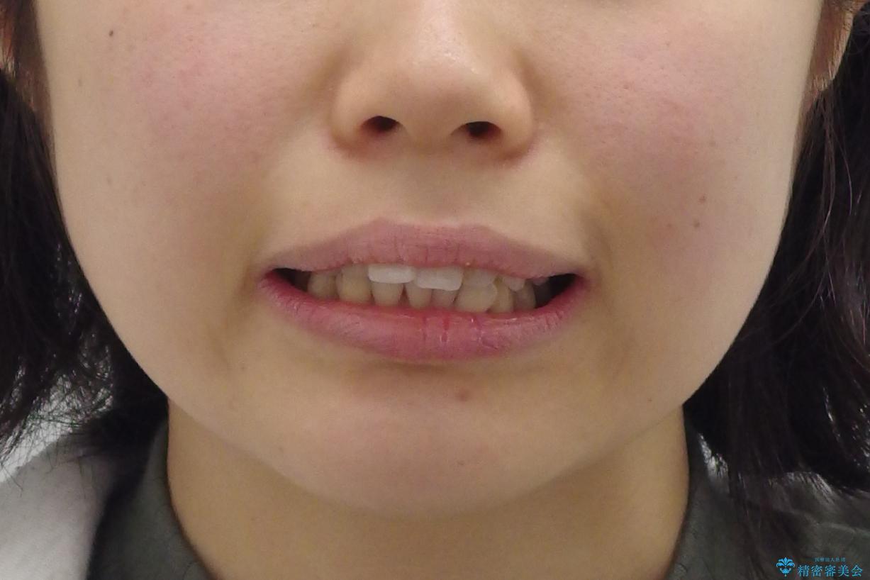「整形した?」と言われるほどの変化! 口元を矯正治療で改善 鼻を高くしたわけでも、アゴに何か入れたわけでもありません。の治療前(顔貌)