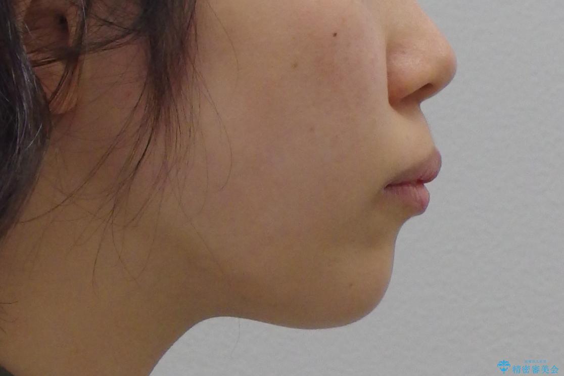 「整形した?」と言われるほどの変化! 口元を矯正治療で改善 鼻を高くしたわけでも、アゴに何か入れたわけでもありません。の治療前(顔貌)