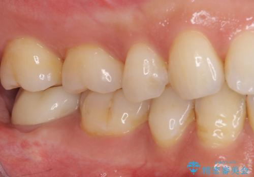 根管治療後の補綴治療 奥歯のセラミッククラウンの治療後