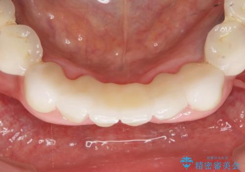 前歯が抜けそう ブリッジできれいに 70代女性の治療後