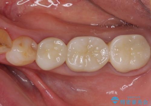 全ての奥歯の銀歯をセラミックに　メタルフリー治療の治療後