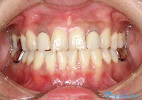 歯の着色落としの治療前