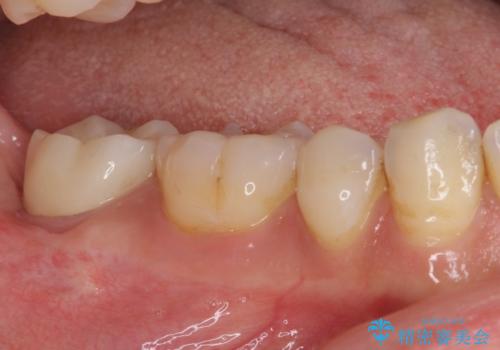 根管治療後の補綴治療 奥歯のセラミッククラウンの治療後