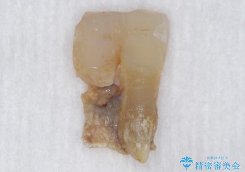 前歯が抜けそう ブリッジできれいに 70代女性の治療前