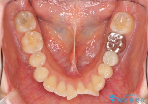 「整形した?」と言われるほどの変化! 口元を矯正治療で改善 鼻を高くしたわけでも、アゴに何か入れたわけでもありません。の治療前
