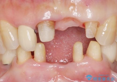 前歯が抜けそう ブリッジできれいに 70代女性の治療中