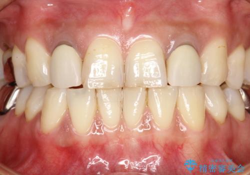 歯の着色落としの治療前