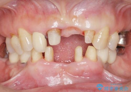 前歯が抜けそう ブリッジできれいに 70代女性の治療中