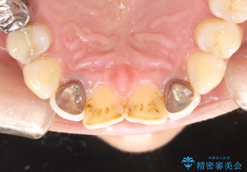 歯の着色落としの治療前