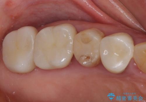 全ての奥歯の銀歯をセラミックに　メタルフリー治療の治療後