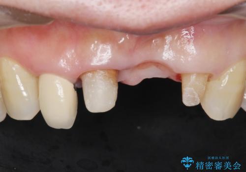 前歯が抜けそう ブリッジできれいに 70代女性の治療中