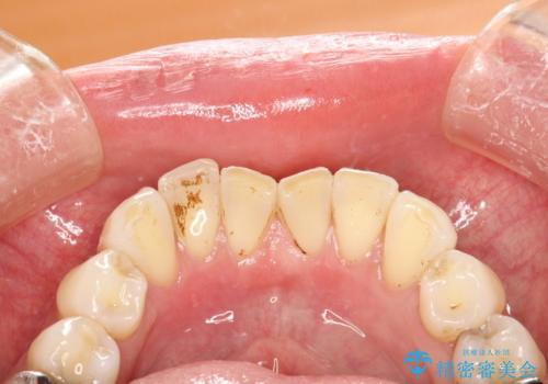 歯の着色落としの治療前