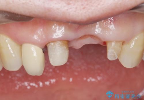 前歯が抜けそう ブリッジできれいに 70代女性の治療中