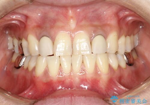 歯の着色落としの治療後