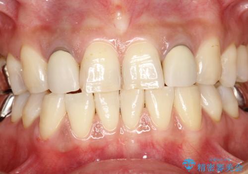 歯の着色落としの治療後