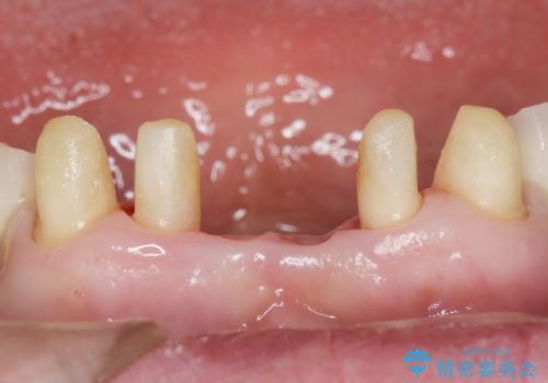 前歯が抜けそう ブリッジできれいに 70代女性の治療中