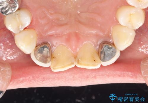 歯の着色落としの治療後