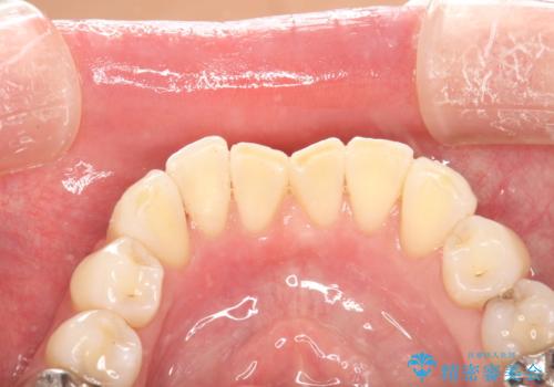 歯の着色落としの治療後