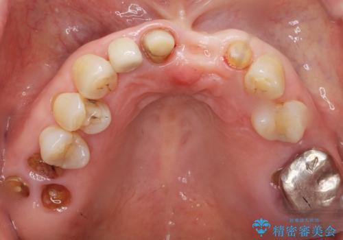 前歯が抜けそう ブリッジできれいに 70代女性の治療中