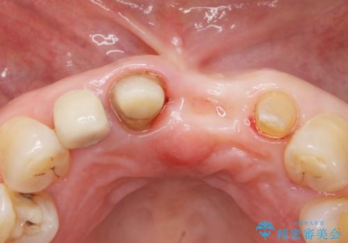 前歯が抜けそう ブリッジできれいに 70代女性の治療中