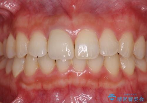 不自然なセラミッククラウンを自然なセラミックにの治療後