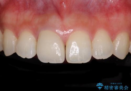 不自然なセラミッククラウンを自然なセラミックにの治療後